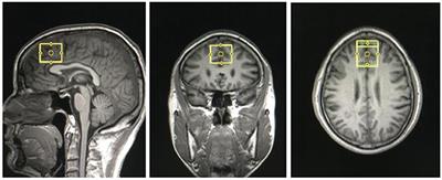 Metabolites Alterations in the Medial Prefrontal Cortex of Methamphetamine Users in Abstinence: A 1H MRS Study